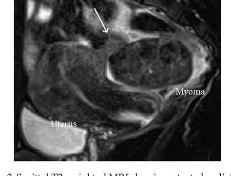 Figure 2 from Torsion of a Subserosal Myoma Managed by Gasless ...