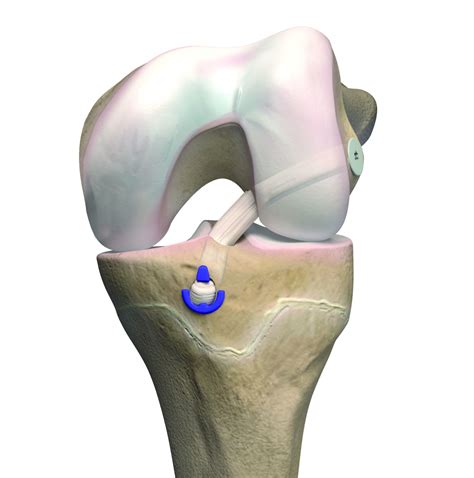 OrthoPediatrics | Sports Medicine | MPFL Reconstruction System