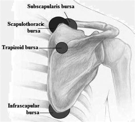 Subscapular Bursitis