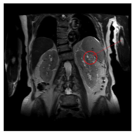 Cureus | Simultaneous Clinical Presentation of Renal Cell Carcinoma and ...