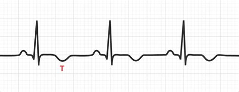 T Wave Inversion | Test Findings - MedSchool