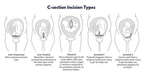 C section - Transverse Baby | BabyCenter