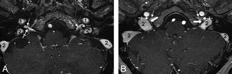 The Jugular Foramen: Imaging Strategy and Detailed Anatomy at 3T ...