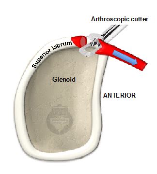 Biceps tenotomy or tenodesis