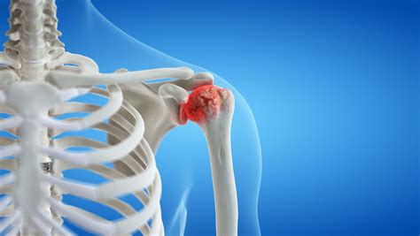 Shoulder Arthritis: What Is It, Symptoms, Treatment, and Prevention ...