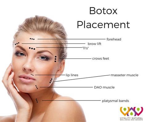 Diagram Botox Lip Flip Injection Points