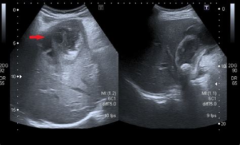 Gallbladder perforation - radiological aspects, types and causes ...