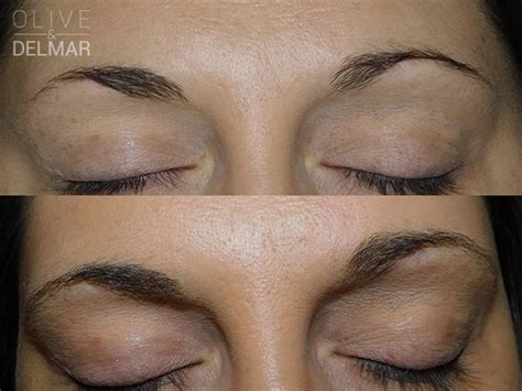 neuLASH and neuBROW Before and After | LovelySkin