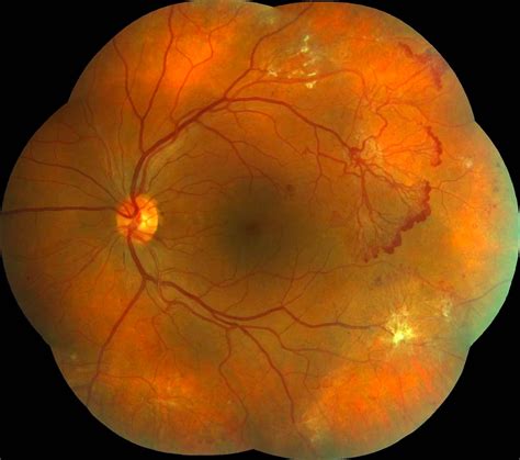 Eye Diseases Retina & Macula Cataract & Glaucoma - EroFound