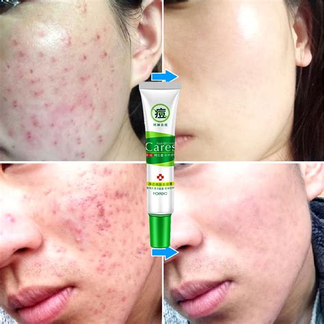 ROREC Acne Treatment Cream Moisturizing skin care acne remover face ...