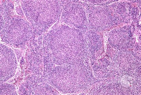 Follicular Lymphoma - 2.