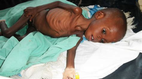 Malnutrition in children on the rise in Iganga - Daily Monitor