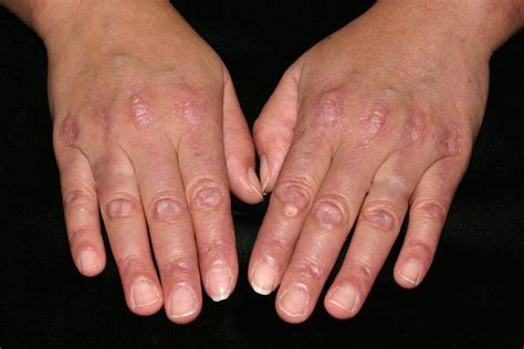 Polymyositis - Causes, Symptoms, Prognosis, Diagnosis, Treatment