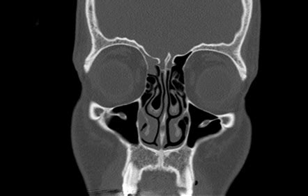 Protrusion of the infraorbital canal into the maxillary sinus ...