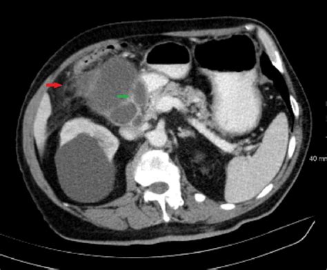 Gallbladder perforation - radiological aspects, types and causes ...