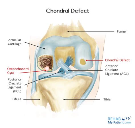 Défaut chondral | Radio Integracion