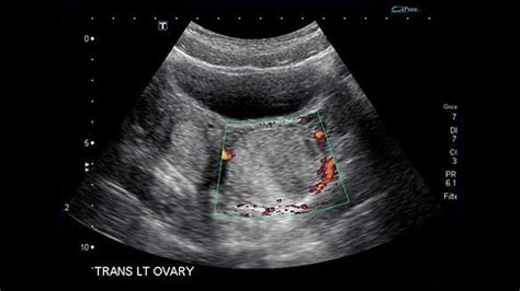 What Do Cysts Look Like On Ultrasound