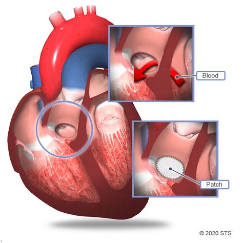 Ventricular Septal Defect Surgery | The Patient Guide to Heart, Lung ...