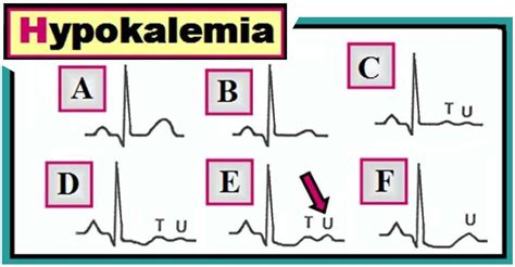 ECG Interpretation: ECG Interpretation Review #27 (ST-T Wave Changes ...