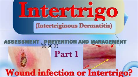 Intertrigo(Intertriginous Dermatitis): Assessment , Prevention and ...