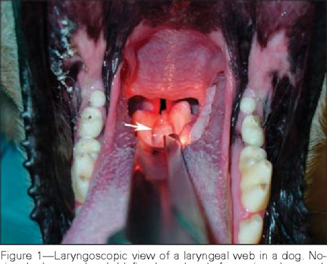 Figure 1 from Outcome of laryngeal web resection with mucosal ...