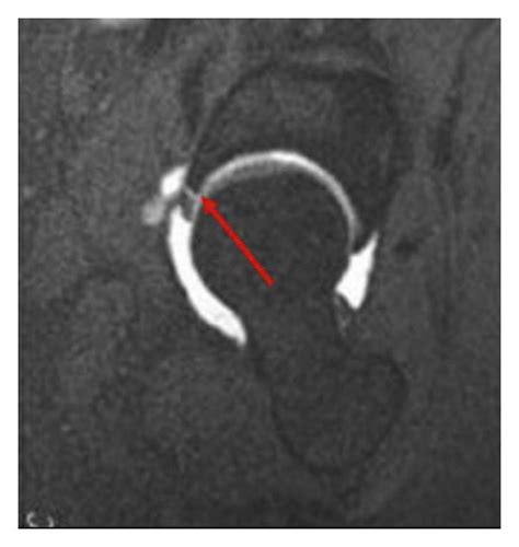 MRI image of hip joint. (a) Original MRI image and (b) image processed ...