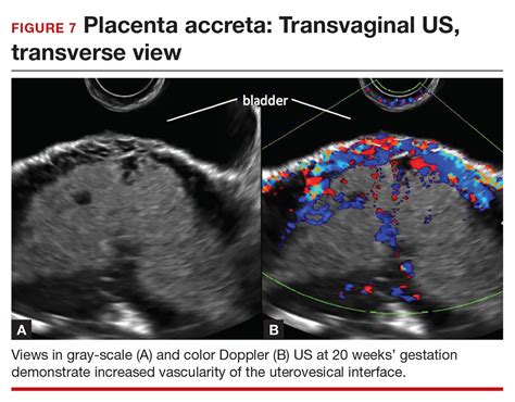 Diagnosing placenta accreta spectrum with prenatal ultrasound | MDedge ...