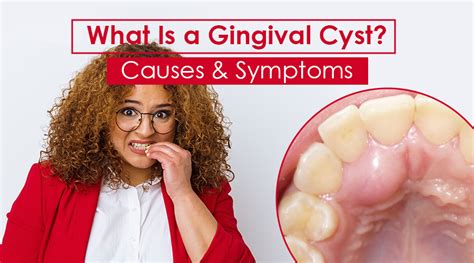 Gingival Cyst Causes, Symptoms & Treatment