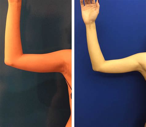 Before & After: Arms Liposuction | Neinstein Plastic Surgery