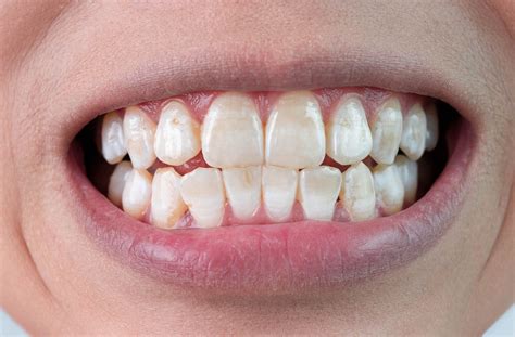 White Spots on Teeth: Causes, Treatment, & Prevention