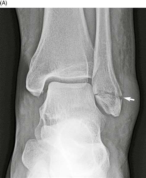 Lateral Malleolus Fracture