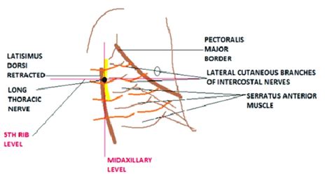 Landmarks of serratus anterior plane block. Figure 3:Schematic ...