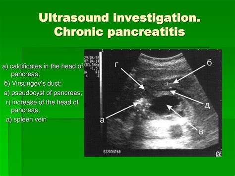 PPT - Chronic pancreatitis PowerPoint Presentation, free download - ID ...