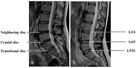 JCM | Free Full-Text | Lumbosacral Transitional Vertebra Contributed to ...