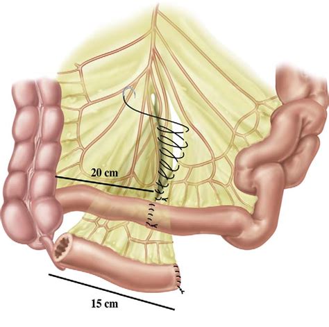 Figure 3 from Ileal Conduit as the Standard for Urinary Diversion After ...