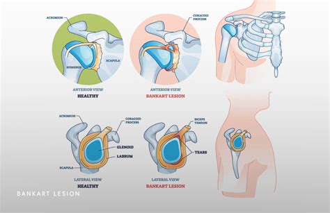 Torn Labrum After Dislocation Schaumburg - Thomas Obermeyer, MD