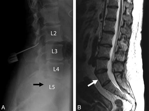 Lumbosacral Transitional Vertebrae: Classification, Imaging Findings ...