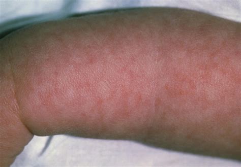 Baby Girl's Arm Showing Rash From Viral Meningitis Photograph by Dr P ...