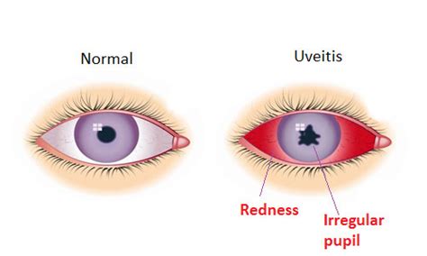 Uveitis - CarysMadyson