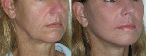 Raise And Tighten Sagging Hog Jowls Naturally With Facial Toning ...