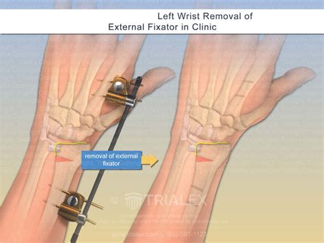 Left Wrist Removal of External Fixator in Clinic - TrialQuest Inc...