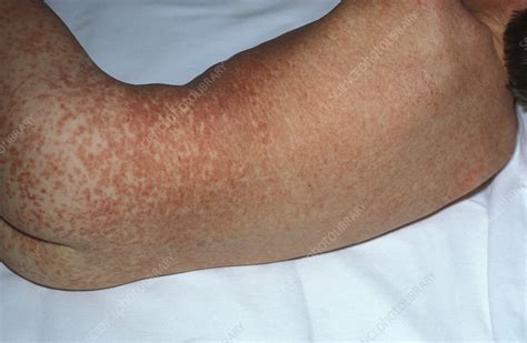 Measles rash - Stock Image - M210/0258 - Science Photo Library