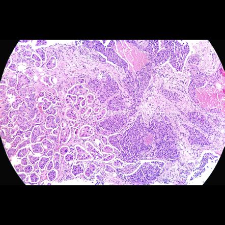 Pathophysiology Of Invasive Ductal Carcinoma