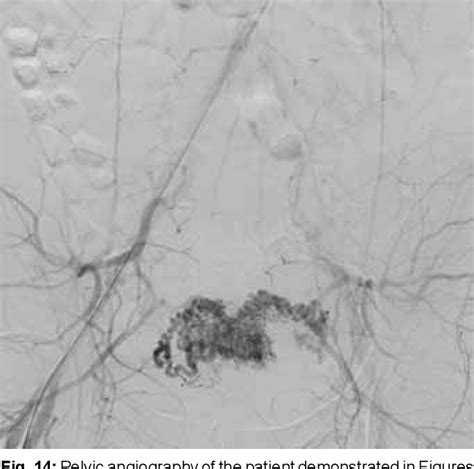 Figure 3 from Ultrasound Imaging of Postpartum Hemorrhage | Semantic ...