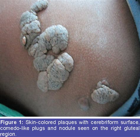 Figure 1 from Nevus Lipomatosus Cutaneous Superficialis: A Rare Case ...