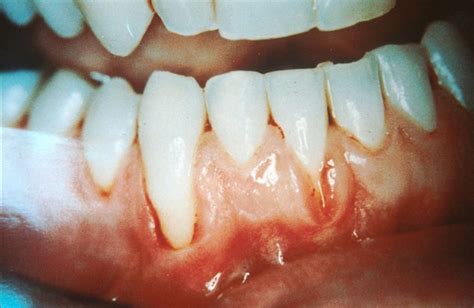 What Are White Gums? Causes And Treatment