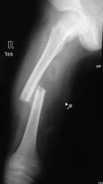 Leg Compound Fracture X Ray - Foto Kolekcija