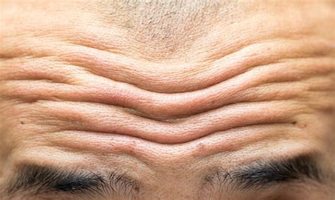 Deep forehead wrinkles early sign of cardiovascular disease, according ...