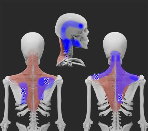 Trapezius Tear Signs Symptoms