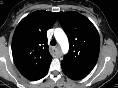 Esophageal Stenosis: A Differential Diagnosis Between Esophageal Cancer ...